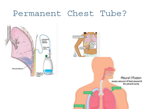 Permanent Chest Tube